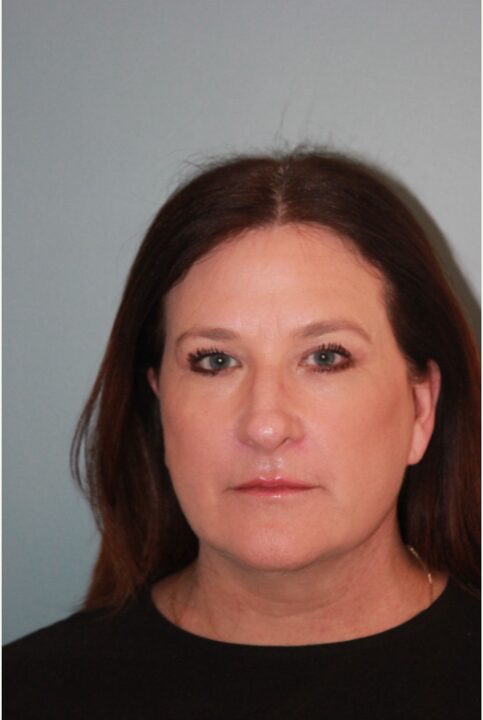 After — Woman treated with Neck Lift