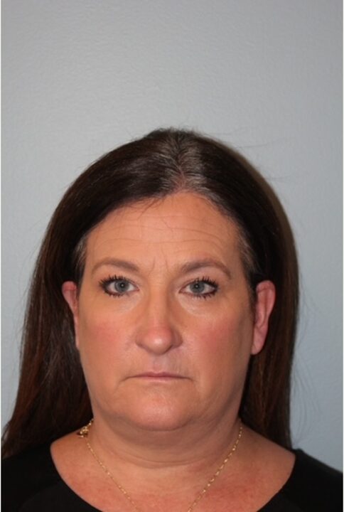Before — Woman treated with Neck Lift