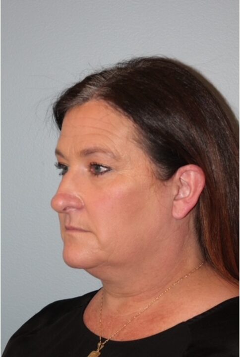 Before — Woman treated with Neck Lift
