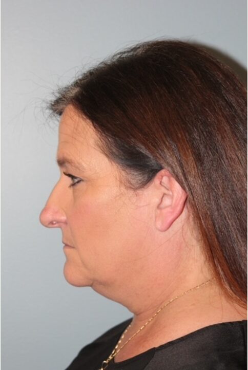 Before — Woman treated with Neck Lift
