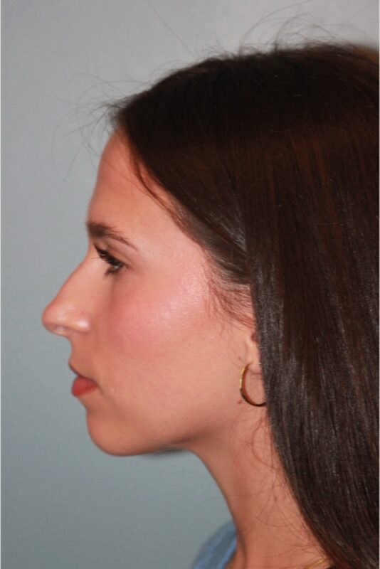 Before — 18-24 year old woman treated with Open Rhinoplasty