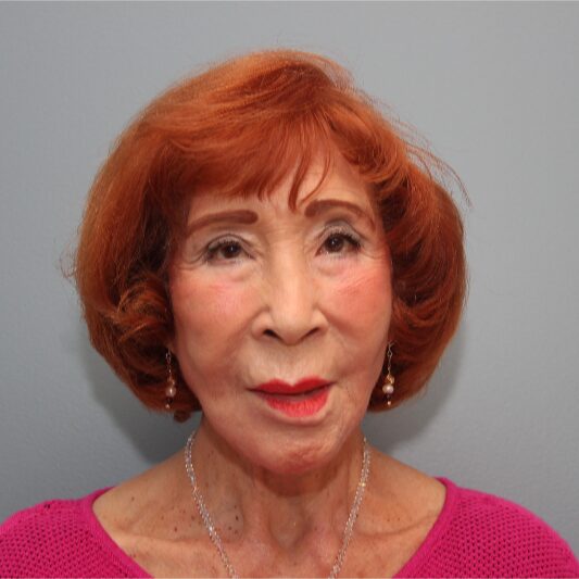 After — 83 year old woman treated with a LiteLift® facelift