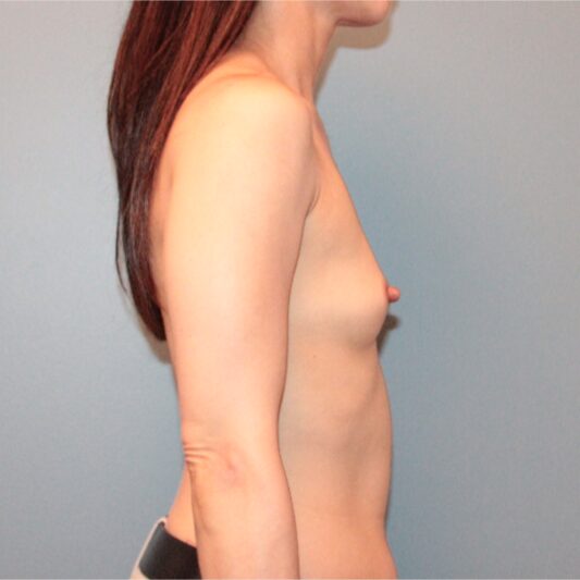 Before — 45 years old first Breast Augmentation