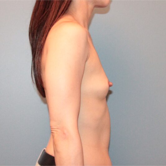 Before — 320 cc Sientra textured round moderate profile silicon implants