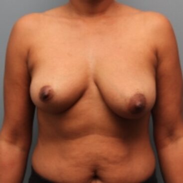 Before — 46 year old woman treated with Breast Augmentation