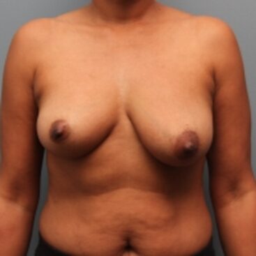 Before — 46 year old woman had breast augmentation with the Ideal Implant