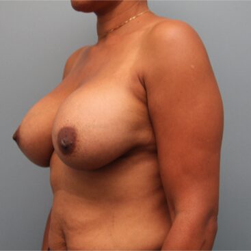 After — Hybrid Breast Implants Used with Breast Augmentation Surgery