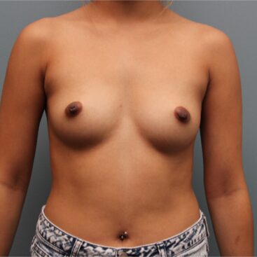 Before — 27 year old woman treated with Breast Augmentation