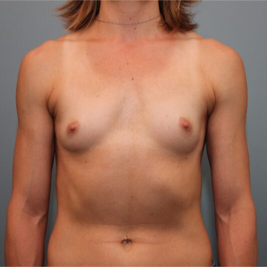 Before — 34 year old woman had Breast Augmentation with Inspira Breast Implants