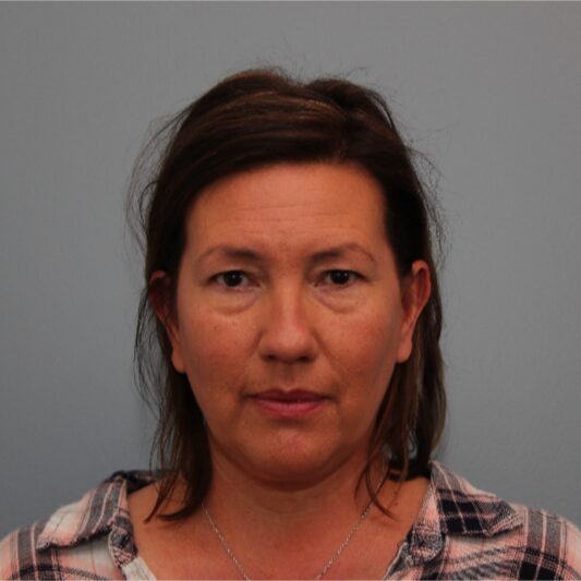Before — Eyelid Surgery was performed on both her upper and lower eyelids