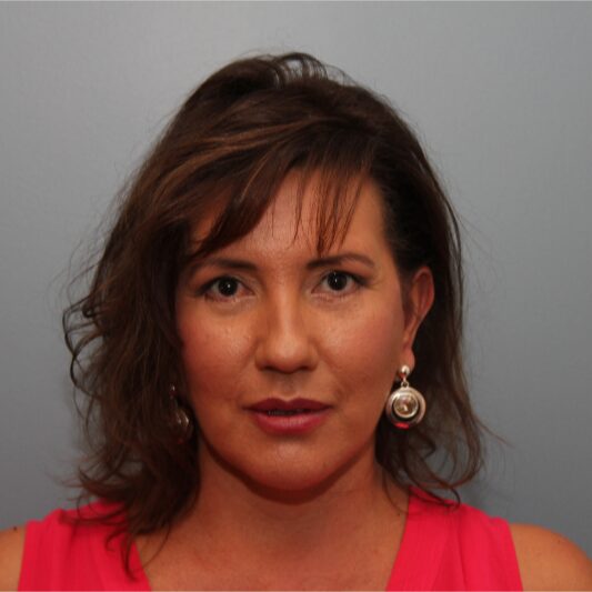After — 49 year old woman treated with Eye Bags Treatment