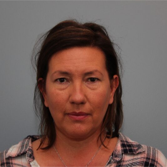 Before — 49 year old woman treated with Eye Bags Treatment