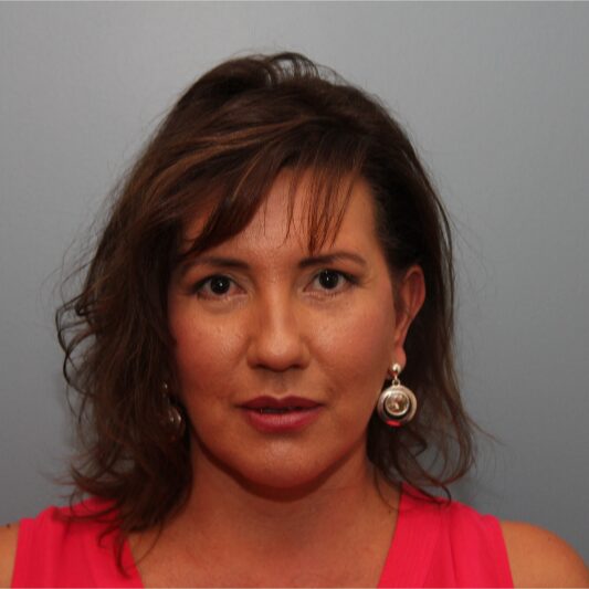 After — Liposuction to the upper neck and pre-jowls