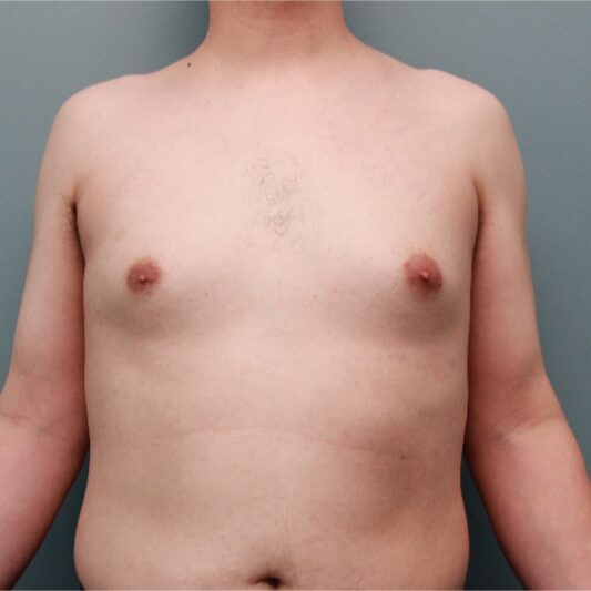 Before — Male Breast Reduction Performed Using Liposuction
