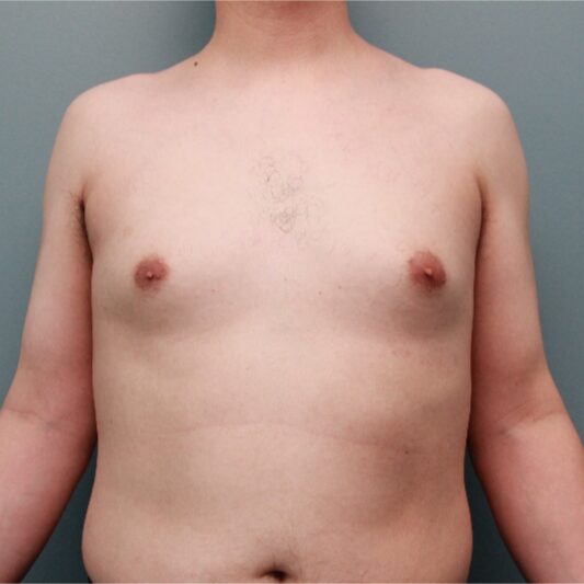 Before — This 20 something year old man was treated with Liposuction to remove gynecomastia