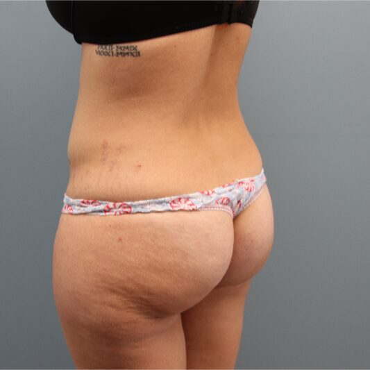 Before — 33  year old woman had Butt Augmentation to add volume and improve shape