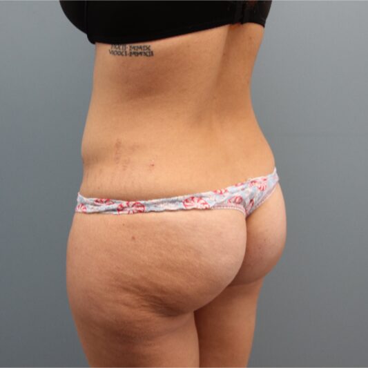 Before — Fat Transfer to the Buttocks was performed on this 33 year old woman
