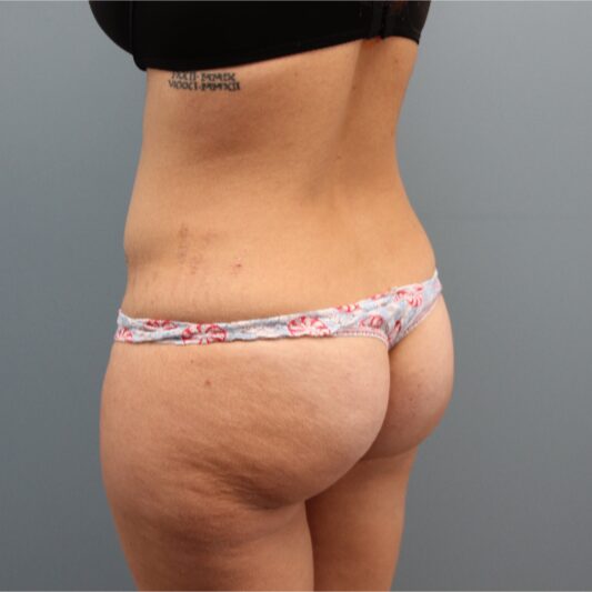 Before — Liposuction of the abdomen, hips, lateral thighs and low back