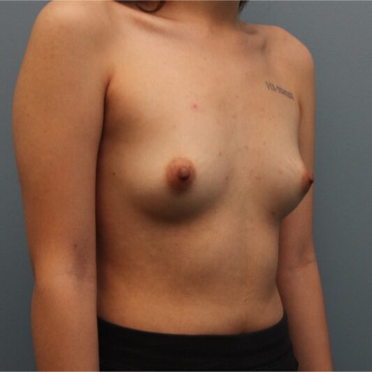 Before — 21 year old woman treated with Breast Augmentation