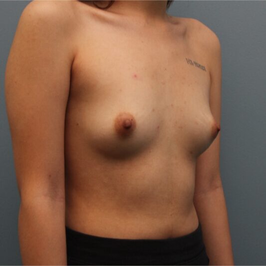 Before — 21 year old treated with 405cc Ideal Implants