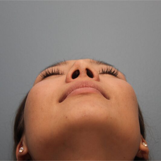 Before — 24 year old woman treated with Nose Surgery