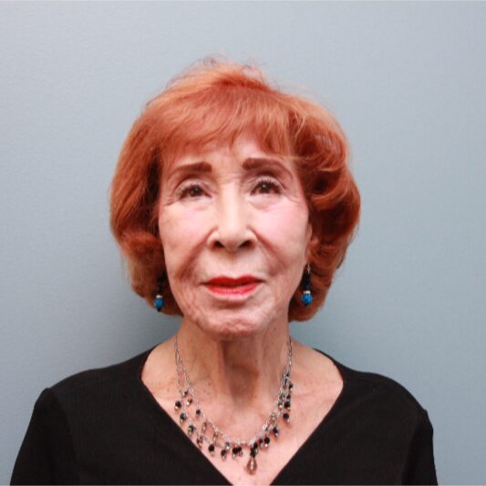 Before — 83 year old woman treated with the LiteLift® which is similar to the Lifestyle Lift
