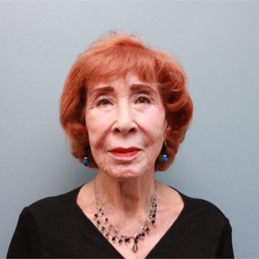 Before — 83 year old woman treated with the LiftLift ® which is similar to the MACS Facelift