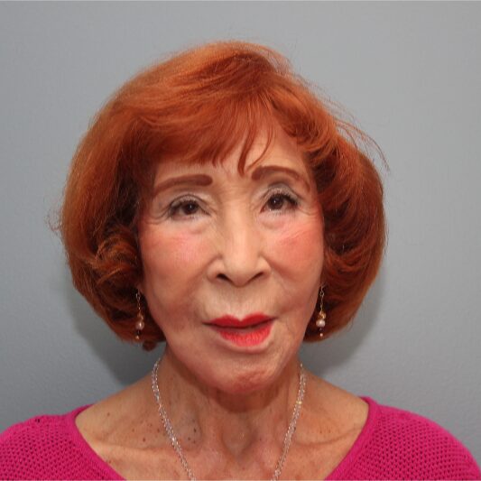 After — 83 year old woman treated with the LiteLift® Mini Lift