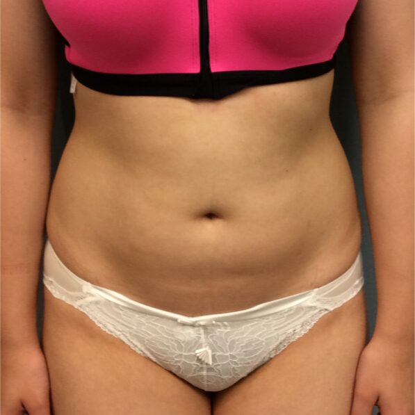 Before — 21 year old was treated with UltraShape