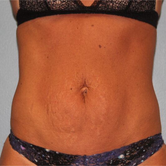 After — 40 year old woman treated with UltraShape fat reduction
