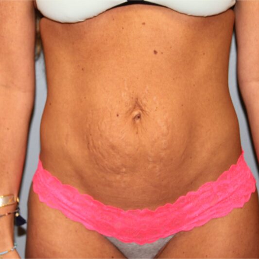 Before — 40 year old woman treated with UltraShape fat reduction