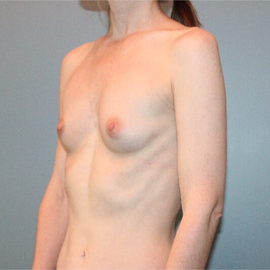 Before — 45 year old woman treated with Breast Augmentation