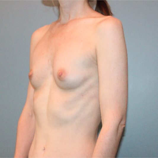Before — 45 year old woman treated with Breast Implants