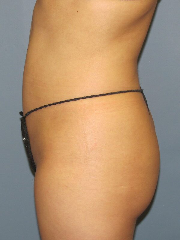 After — Fat Transfer