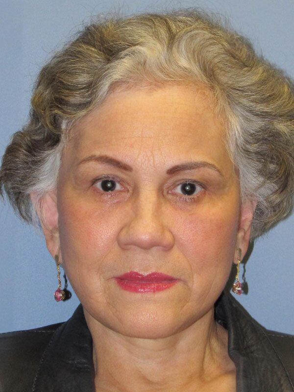 After — Brow Lift