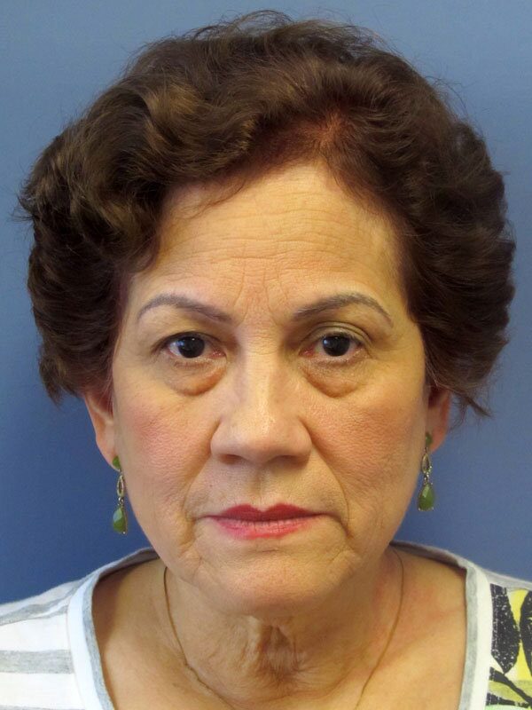 Before — Brow Lift