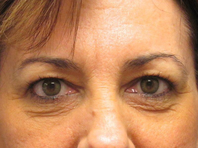 Before — Eyelid Surgery