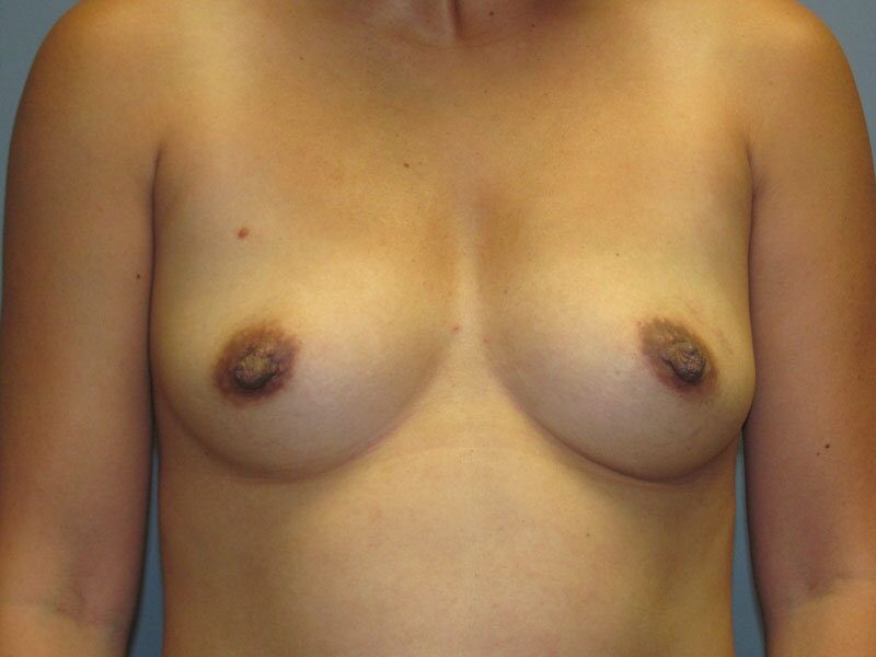 Before — Breast Augmentation