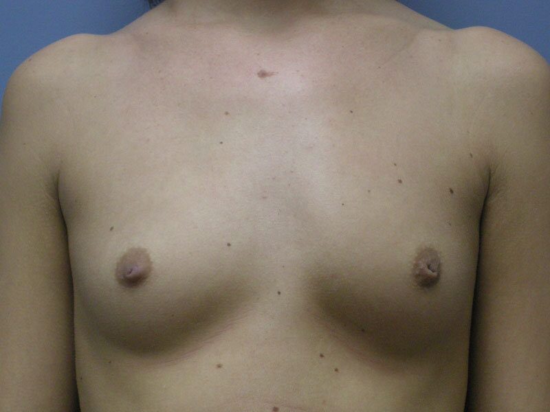 Before — Breast Augmentation