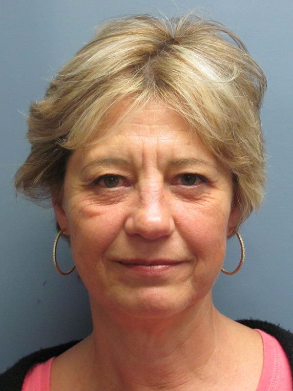 Before — Brow Lift, Eyelid Lift