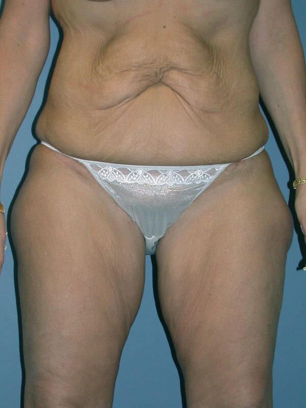Before — Tummy tuck, liposuction