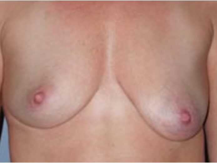 Before — 35-44 year old woman treated with Breast Reconstruction