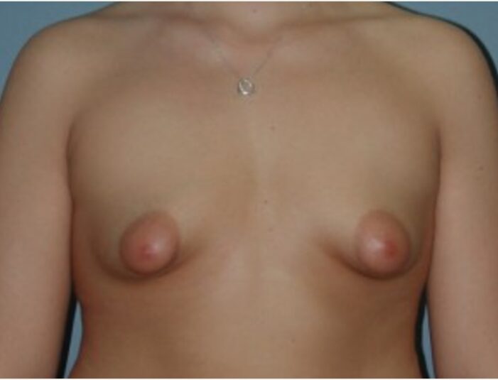 Before — 23 year old woman treated with Breast Reconstruction
