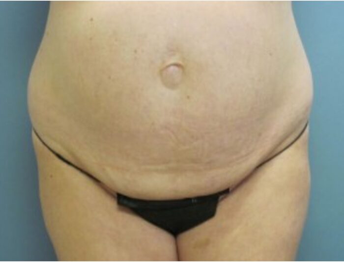 Before — Liposuction on a 32 year old woman
