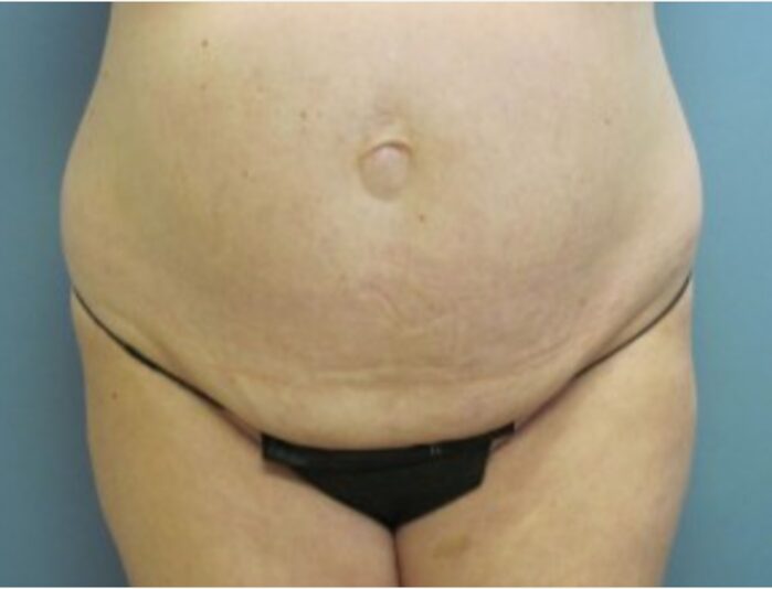Before — 32 year old woman treated with Tummy Tuck
