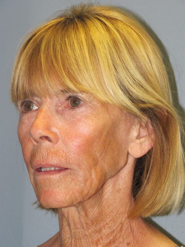 Before — Lite Lift, Blue Peel