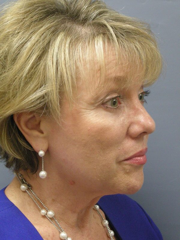 After — Lite Lift™
