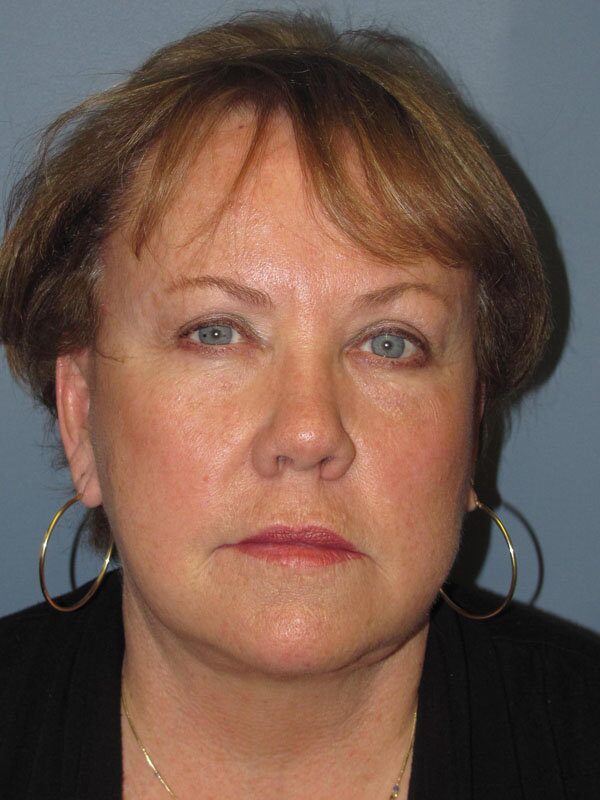 After — Lite Lift, liposuction of the neck, eyelid lift, brow lift