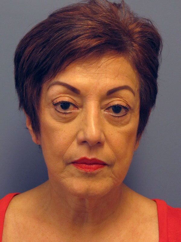 Before — Lite Lift, neck lift, eyelid lift