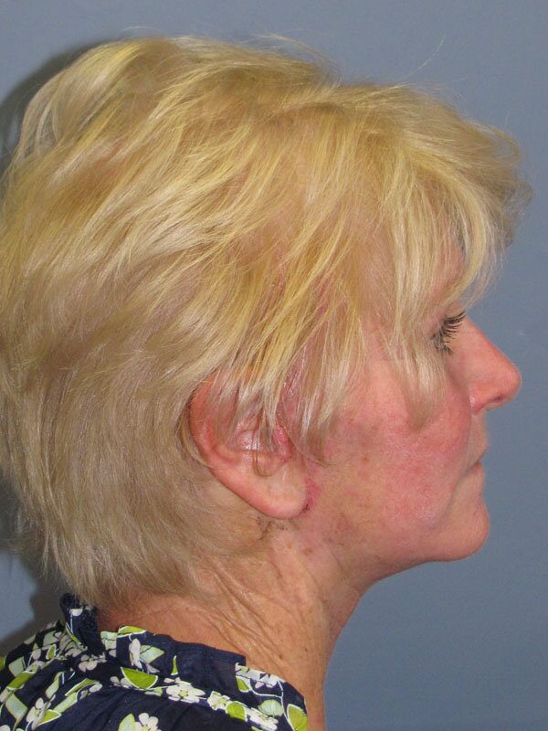 After — Lite Lift, Blue Peel